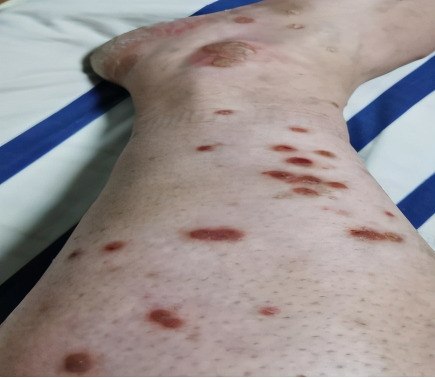 病例分享｜银屑病8年患者，采用中药调理，半个月就见好转