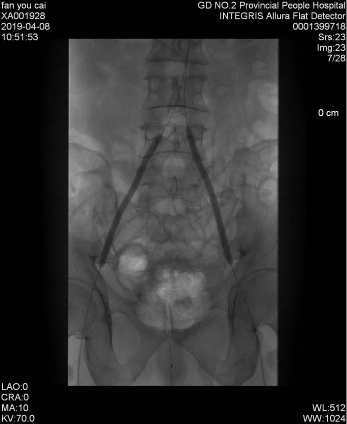 老烟民请注意,老烟民血管收缩