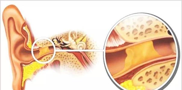 耳朵里老有耳屎一挖就出血,耳朵里面有耳屎能不能挖