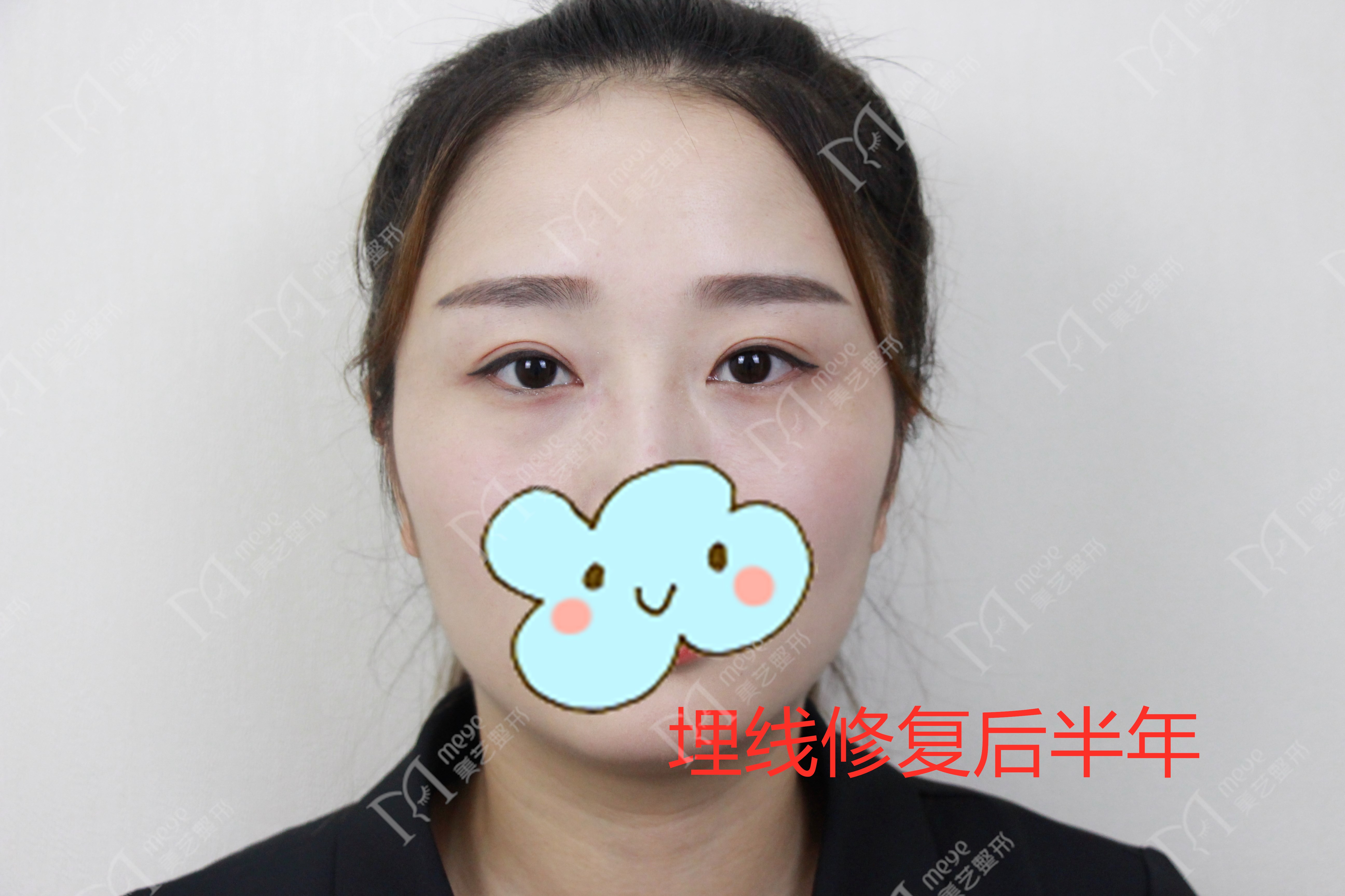 双眼皮失败了怎么修复好,双眼皮修复失败怎么解决