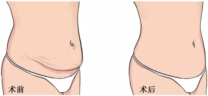 腹壁整形方法是什么呢图片,腹壁整形多久能大幅度运动