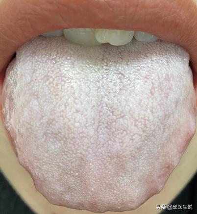 湿热寒湿痰湿并存怎么调理,寒湿型湿气