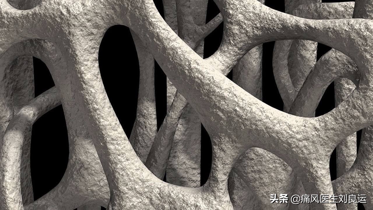 痛风血钙高,尿酸高引起的痛风骨头啥样的