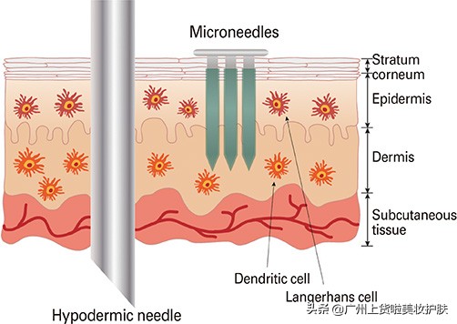 美容微针与滚针的区别在哪,最新技术的微针