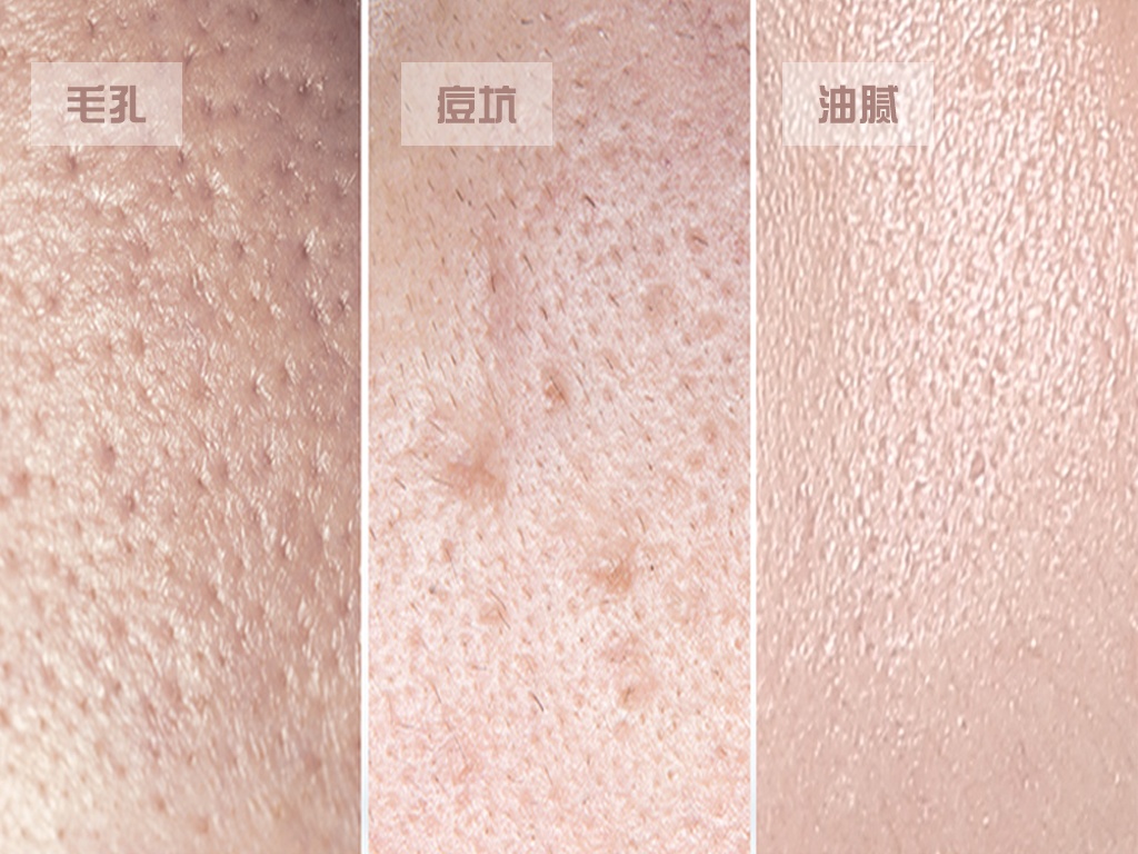 毛孔粗大该如何高效护理,毛孔粗大的解决方法小妙招