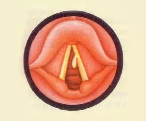 声带息肉不典型什么意思,声带息肉判断良性和恶性
