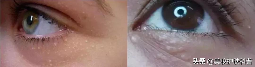 容易长脂肪粒用什么眼霜,为什么一用眼霜就长脂肪粒