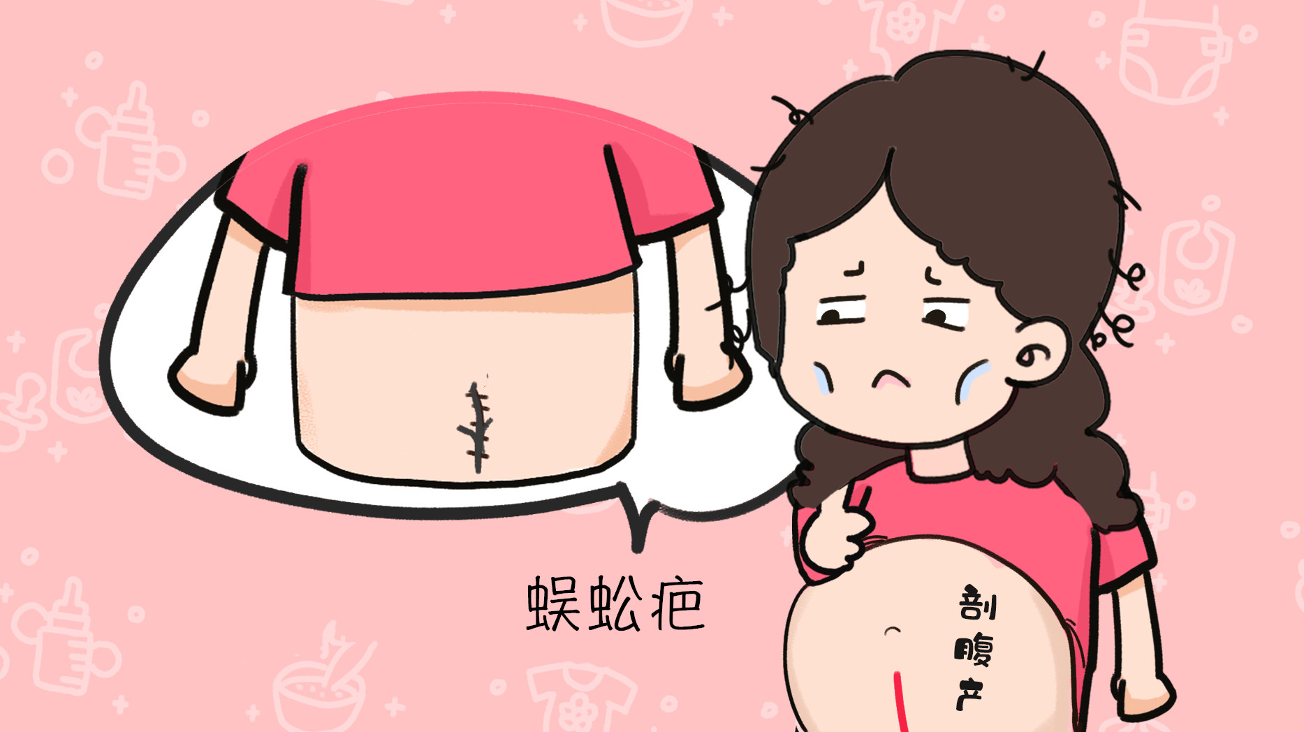 为什么剖腹产不用缝线了,为什么现在剖宫产不用拆线