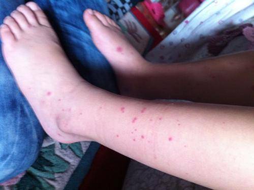 儿童过敏性紫癜尿潜血多久消失,儿童过敏性紫癜痊愈后尿潜血反复