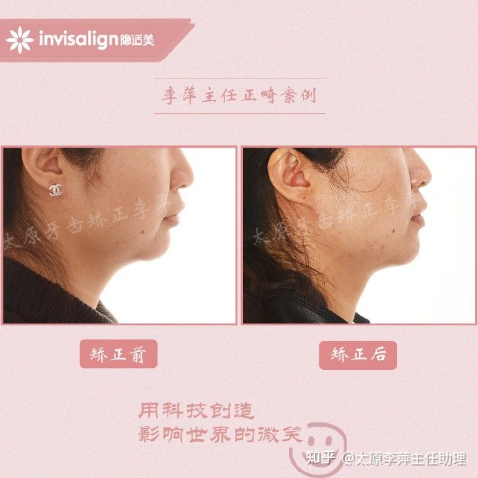 太原牙齿矫正靠谱吗,太原成人隐形牙套牙齿不齐