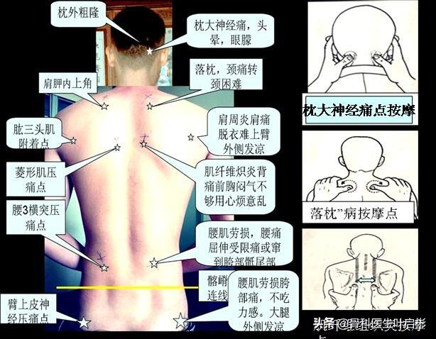 经常背痛贴的膏药,背酸痛贴膏药有用吗