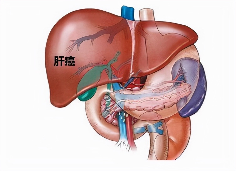 肝癌用靶向药可治愈肝癌吗,肝癌的防治干预计划