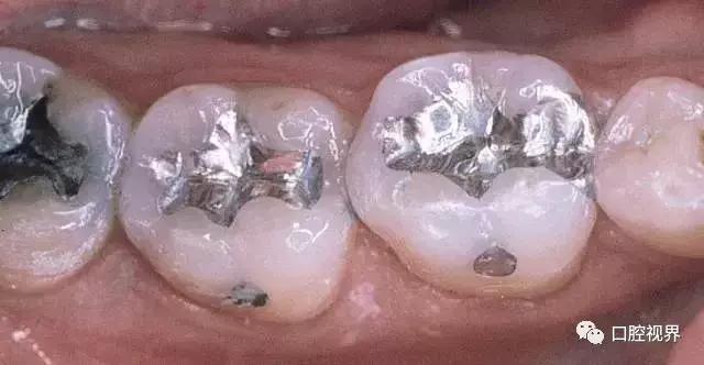 补牙材料银汞合金对身体有害吗,补牙银汞合金是膨胀材料吗