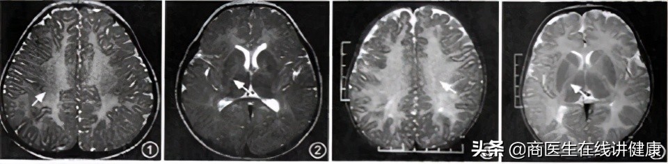 佩梅病临床治疗,佩梅病病情发展