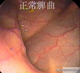 结肠镜检查，痛苦并快乐着
