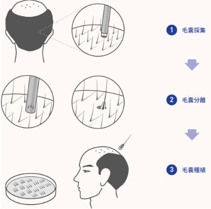 男人脱发这件事是不是就无药可救了