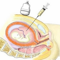 我生了水囊瘤的宝宝,得了淋巴管瘤能生孩子吗