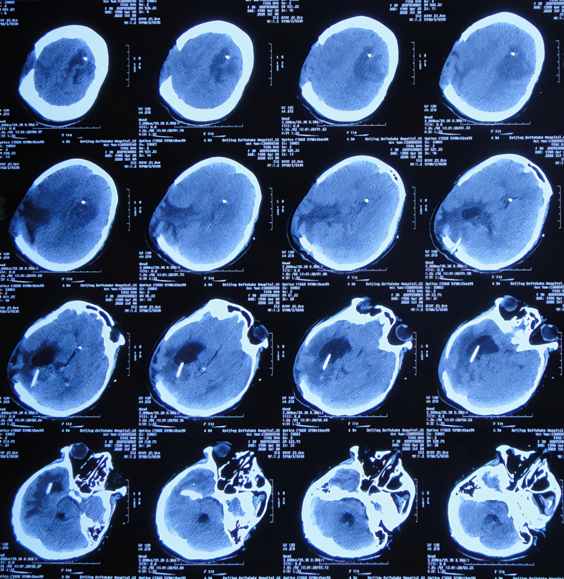 脑室有粘连脑积水有什么办法,脑动脉畸形手术后出现急性脑积水