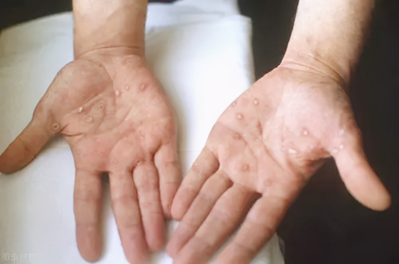 历史上梅毒,梅毒的来源历史