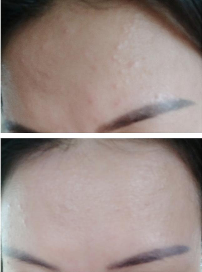 爆痘闭口做什么项目,爆闭口怎么办