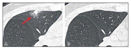 肺CT报告中的肺结节GGO是什么东西？到底是不是癌？