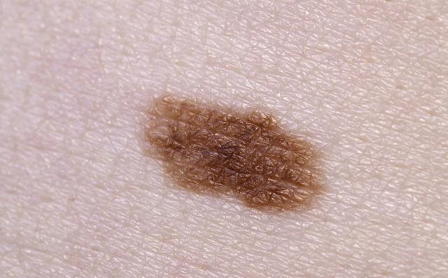 黑色素痣恶化为黑色素瘤的前兆,黑色素瘤会不会危及生命