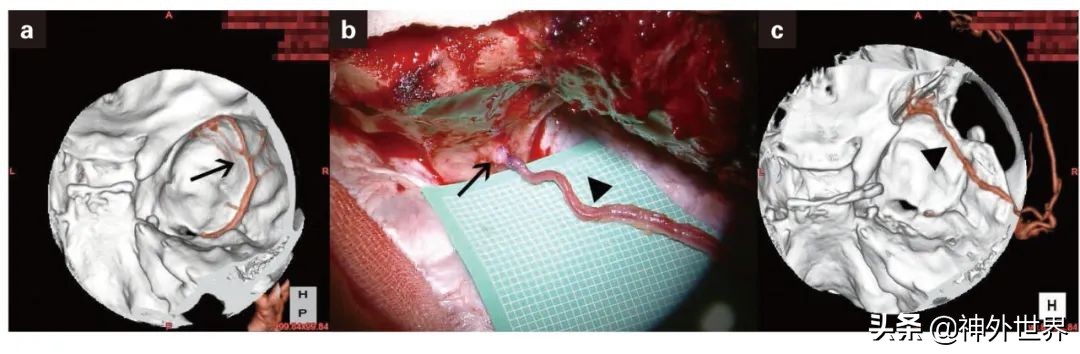 日本治神经损伤特效药,脑动脉炎症状与治疗
