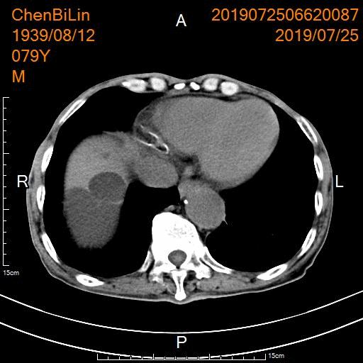 肝硬化肝囊肿要治疗吗,肝包虫囊肿与肝囊肿