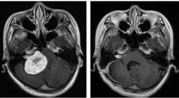 被誉为“抗癌神器”的质子治疗,这几类患者最适合