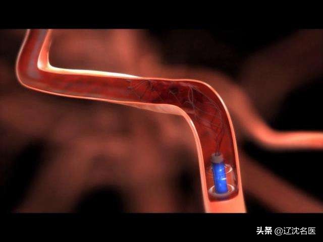 脑血栓血栓一年了还可以取出吗,脑血栓怎么取出血栓