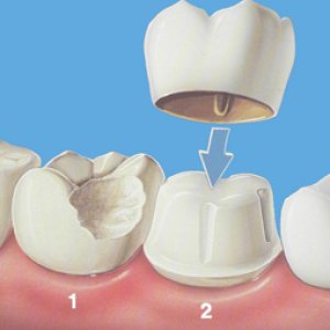 钴铬合金烤瓷牙牙龈变黑怎么处理,烤瓷牙崩瓷了怎么修复