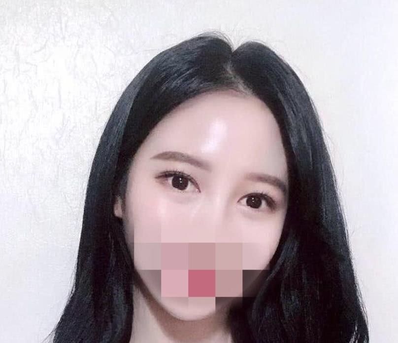 去皮去脂双眼皮恢复大概多长时间,全切双眼皮去皮去脂完全恢复视频