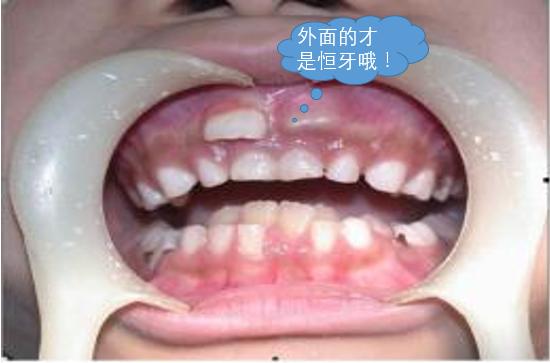 9岁孩子口内出现双排牙，怎么办｜莫急，口腔医生为你支一招