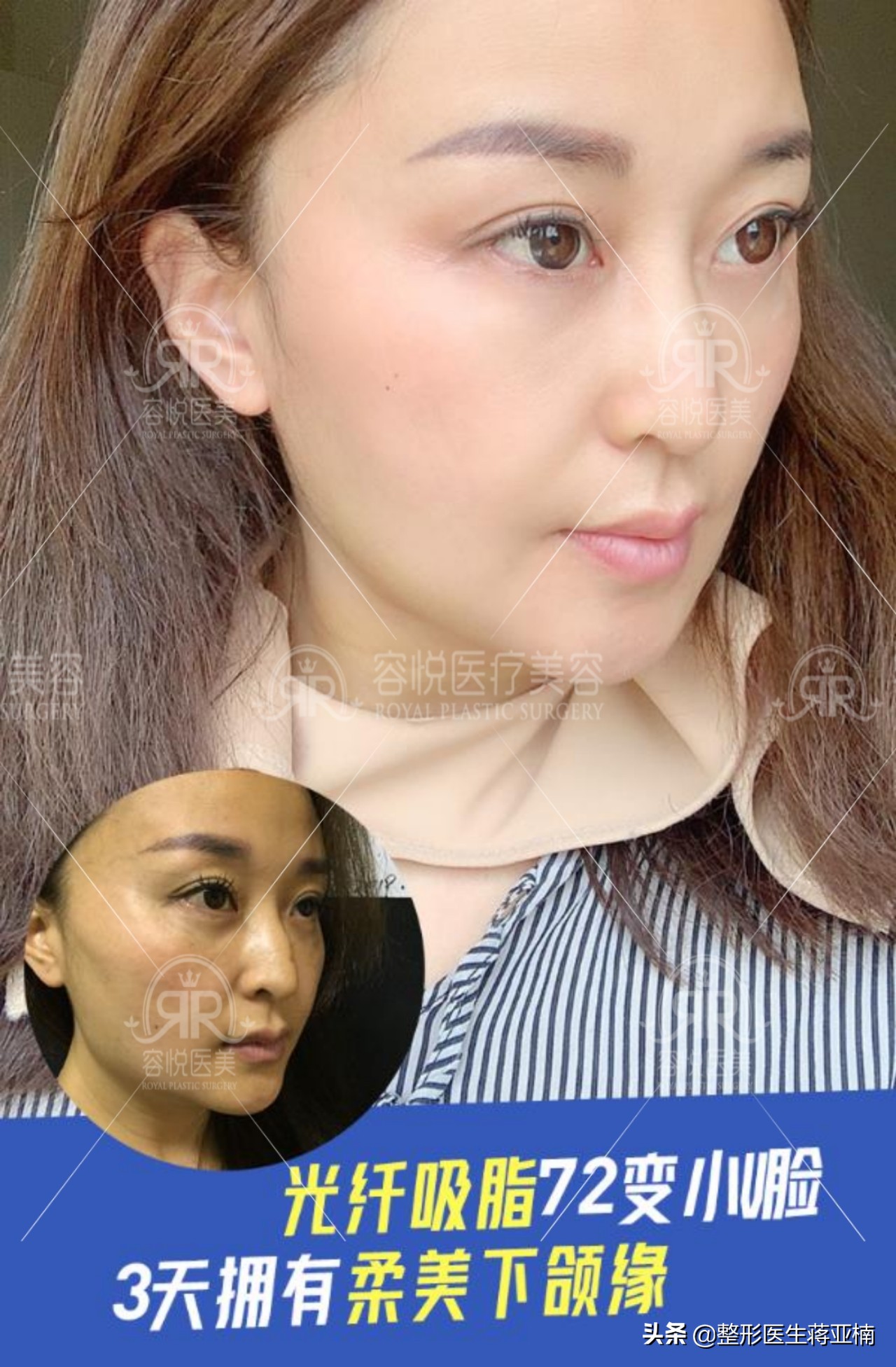 蒋亚楠整形做得怎么样,蒋亚楠整形医生完整视频