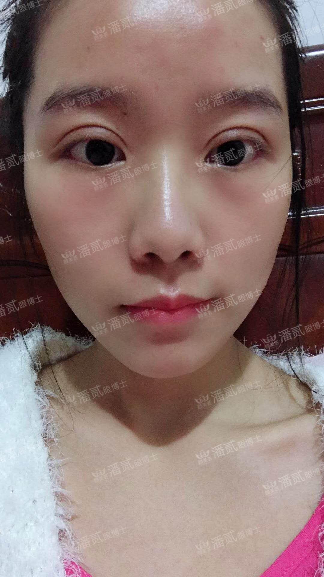 双眼皮整容失败眼皮跳动,双眼皮整形失败修复还花钱吗