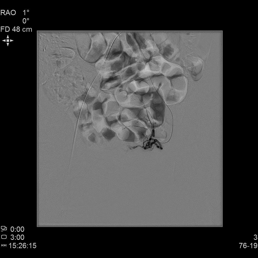 子宫腺肌症「不死的癌症」——介入栓塞来帮忙