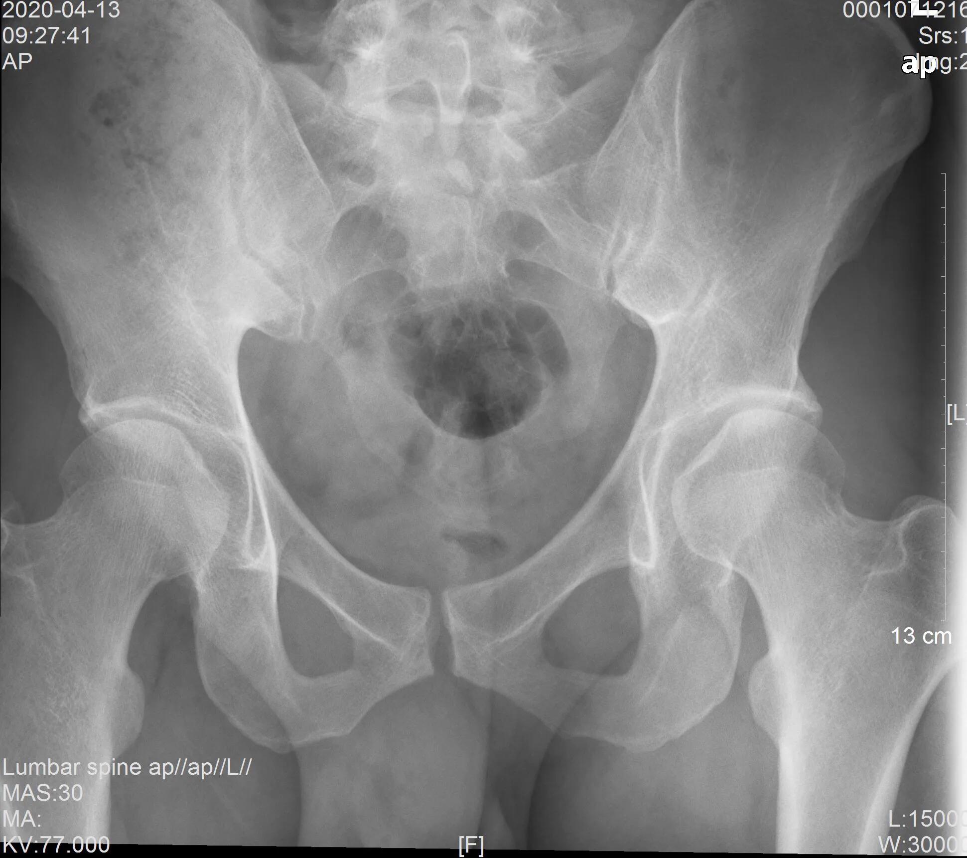 痔疮外痔形成原因,痔疮的形成和治疗