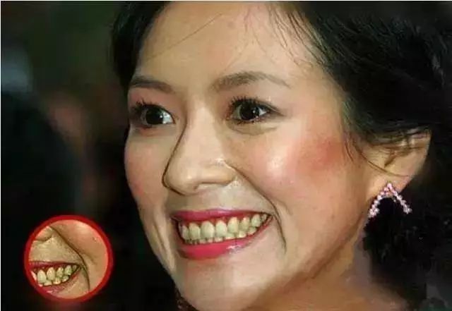 14岁牙齿黄可以洗牙变白吗,牙齿出血发黄去洗牙