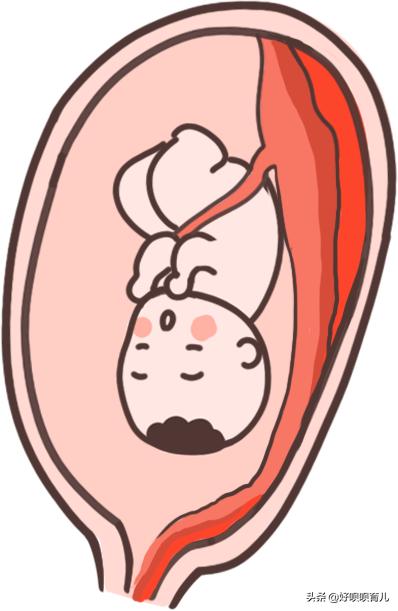 孕晚期羊水破了医生说一直等着,孕妇羊水破了很淡定回家