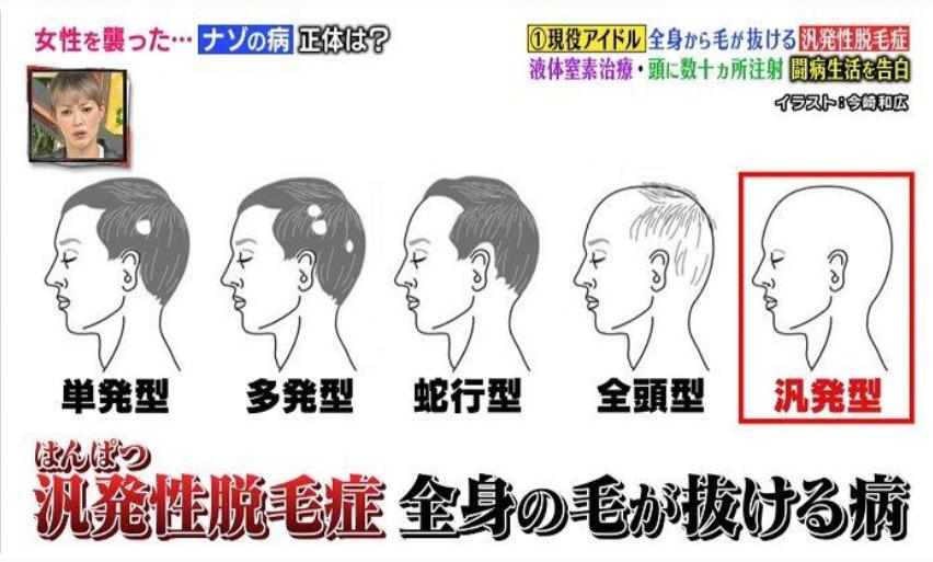 日本15岁脱毛症状,日本脱毛症
