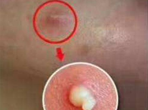 如何彻底消灭在痘痘里的螨虫,痘痘里面有米粒怎么全部去除