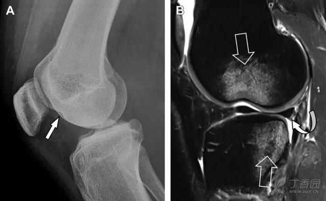 放射科夜班病例大全,放射科容易漏诊的骨折