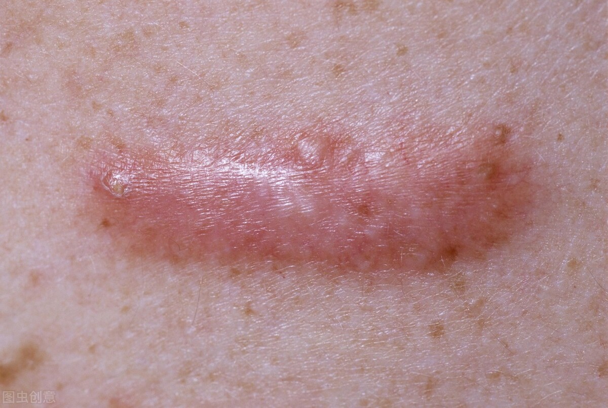 疤痕疙瘩发痒怎么治疗,疤痕疙瘩发痒涂什么药