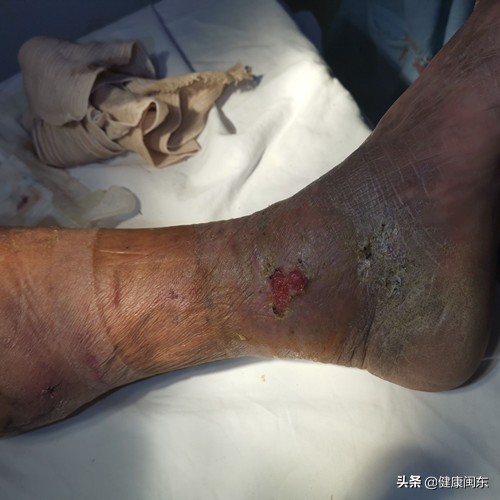 下肢动脉粥样硬化闭塞中药针剂,下肢动脉硬化闭塞症插管溶栓治疗