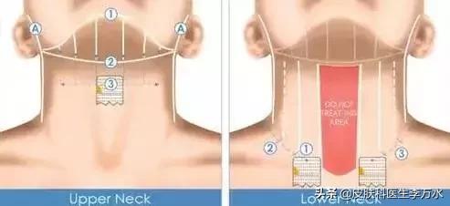 超声刀美容真的像张雨绮吗,张雨绮超声刀图片