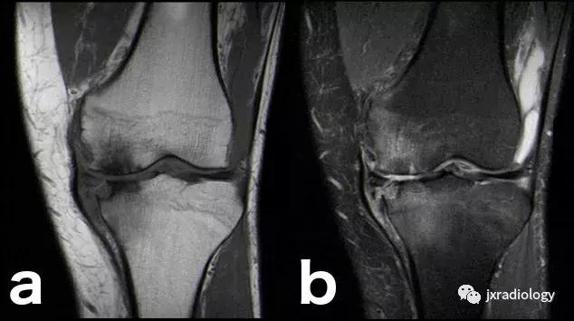 磁共振骶髂关节骨髓水肿是强直吗,磁共振显示骨髓水肿什么意思