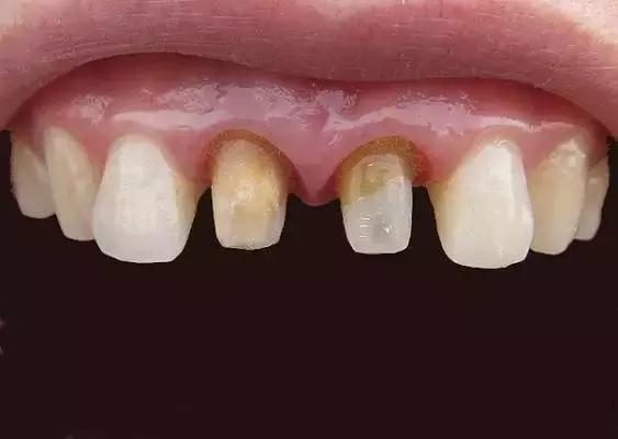 烤瓷牙瓷掉了光剩金属了有毒吗,烤瓷牙里面的金属有毒吗