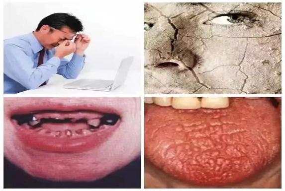 得了干燥综合症怎样用药,干燥综合征注意事项