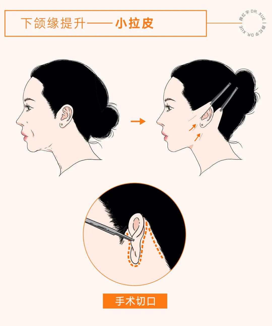 让下颚越来越清晰,下颌缘不清晰的原因