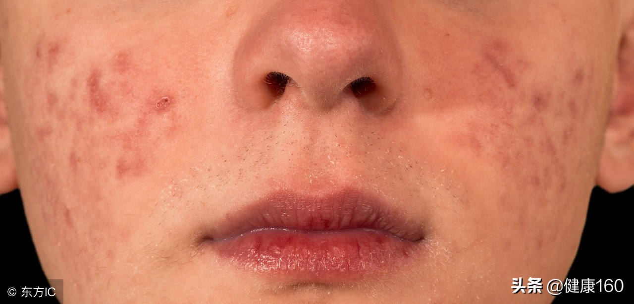 这个药膏几乎人人用过,滥用会毁脸,如何识别药店人员推销?